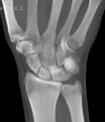 Scaphoid Fracture - CTisus CT Scan