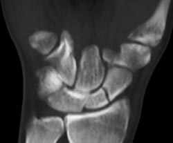 Scaphoid Fracture - CTisus CT Scan