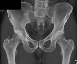 Lymphangioma Right Iliac Wing - CTisus CT Scan