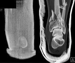 Comminuted Tibial/fibula Fractures - CTisus CT Scan