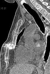 Non-union Sternal Fracture - CTisus CT Scan