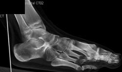 Tarsal Coalition - CTisus CT Scan