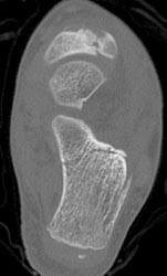 Calcaneal Fracture - CTisus CT Scan