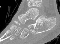 Calcaneal Fracture (peds) - CTisus CT Scan