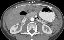 Mesh in Abdominal Wall - CTisus CT Scan