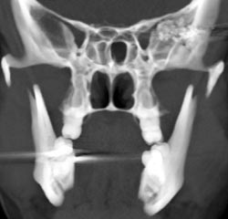 Left Temporal Bone Fractures - CTisus CT Scan