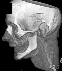 Normal Zygomatic Arch - CTisus CT Scan