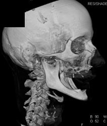 Base of Skull - CTisus CT Scan