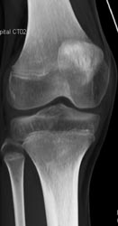 Displaced Patella - CTisus CT Scan