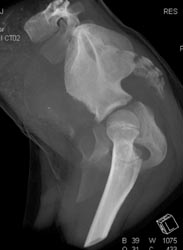 Congenital Hip Disease - CTisus CT Scan