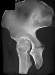 Acetabular Fracture - CTisus CT Scan