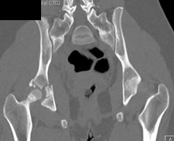 Acetabular Fracture - CTisus CT Scan