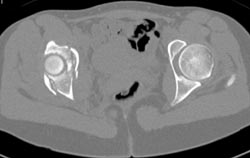 Acetabular Fracture - CTisus CT Scan