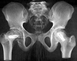 Slipped Capital Femoral Epiphysis (SCFE) With Hip Pinnings - CTisus CT Scan