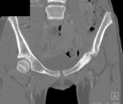 Cystic Changes in Left Acetabulum - CTisus CT Scan