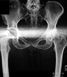 Total Hip Replacement (THR) Without Dislocation - CTisus CT Scan