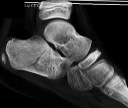 Calcaneus Fracture - CTisus CT Scan