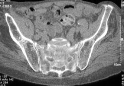 Stress Fracture Sacrum - CTisus CT Scan