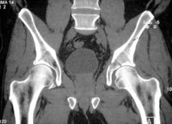 Left Anterior Column Fracture - CTisus CT Scan