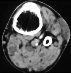 Neurofibromatosis - CTisus CT Scan