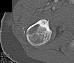 Osteoid Osteoma - CTisus CT Scan