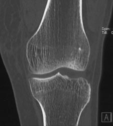 Tibial Plateau Trauma - CTisus CT Scan