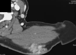 Malignant fibrous histiocytoma (MFH) Shoulder - CTisus CT Scan