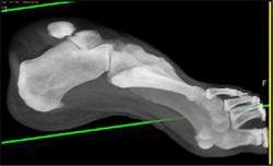 Calcaneal Spurs - CTisus CT Scan