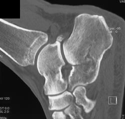 Calcaneal Fracture - CTisus CT Scan