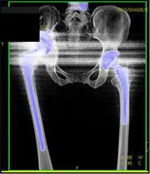 Failed Total Hip Replacement (THR) - CTisus CT Scan