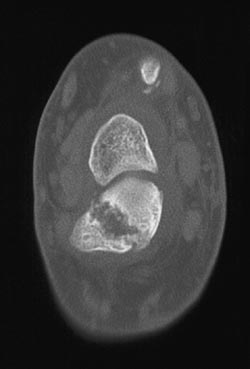 Nonunion Following Fracture - CTisus CT Scan