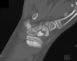 Nonunion Scaphoid Fracture - CTisus CT Scan