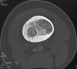 Osteoid Osteoma - CTisus CT Scan