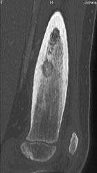 Osteoid Osteoma - CTisus CT Scan