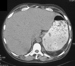 Extramedullary Hematopoiesis - CTisus CT Scan