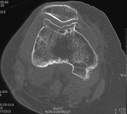 Degenerative Joint Disease (DJD) With Large Osteophytes - CTisus CT Scan