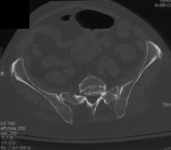 Stress Fracture Sacrum - CTisus CT Scan