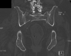 Stress Fracture Right and Left Sacrum - CTisus CT Scan