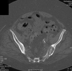 Secondary Hypoparathyroidism With SI Joint Erosions - CTisus CT Scan