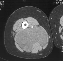 Neurofibrosarcoma - CTisus CT Scan