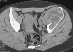 Aneurysmal Bone Cyst (ABC) With Fluid Filled Levels - CTisus CT Scan