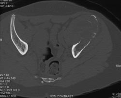 Aneurysmal Bone Cyst (ABC) Iliac Wing - CTisus CT Scan