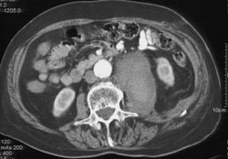 Active Leak Into A Psoas Hematoma - CTisus CT Scan