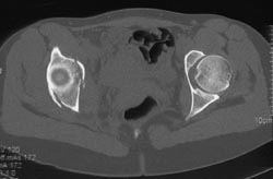 Acetabular Fracture - CTisus CT Scan