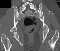 Acetabular Fracture - CTisus CT Scan