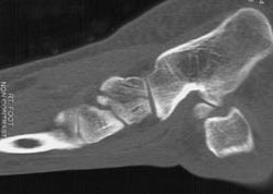 Cuboid Fracture - CTisus CT Scan