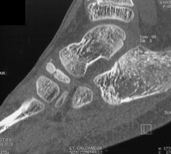 Calcaneal Fracture - CTisus CT Scan