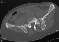 Sacral Fracture - CTisus CT Scan