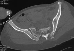 Pelvic Ring Fracture - CTisus CT Scan