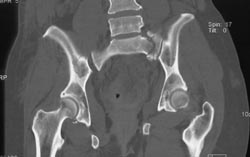 Diastasis Right SI Joint and Fracture Left Side of Sacrum - CTisus CT Scan